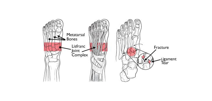 FDA Clears Nextremity Solutions’ Midfoot Fusion System