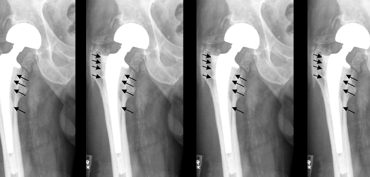 Mayo Study: Mitigate Failures at Time of Primary THA