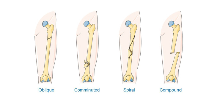 COVID-19 Is More Severe in Fracture Patients