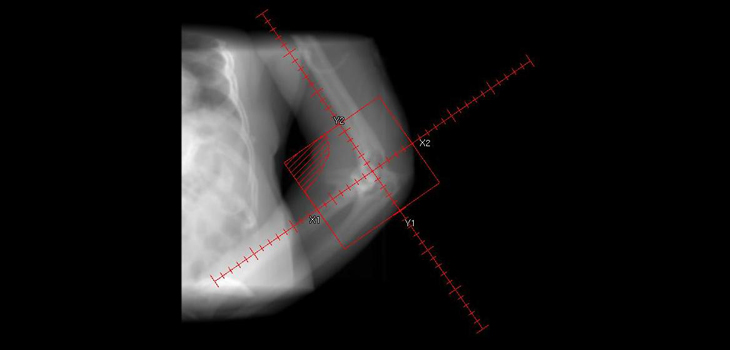 Diabetes Is Risk Factor for Infection After Elbow Arthroscopy