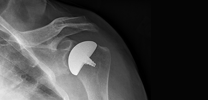 How Do Inlay Glenoid Components Perform in Young Patients?