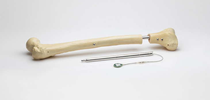 Orthofix Acquires FITBONE Limb Lengthening System