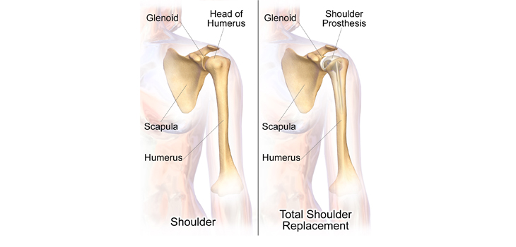 New Digital Platform Personalizes Shoulder Arthroplasty