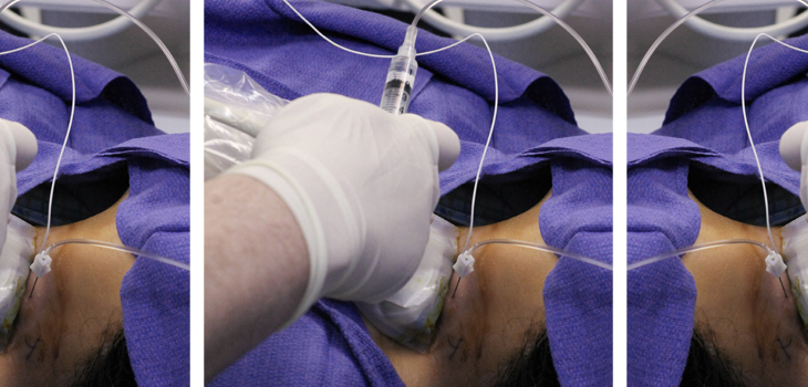 72-Hour Knee Analgesic (NaV1.7) Shows Early Promise
