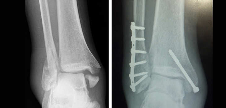 Treating Ankle Fractures as an Outpatient Procedure