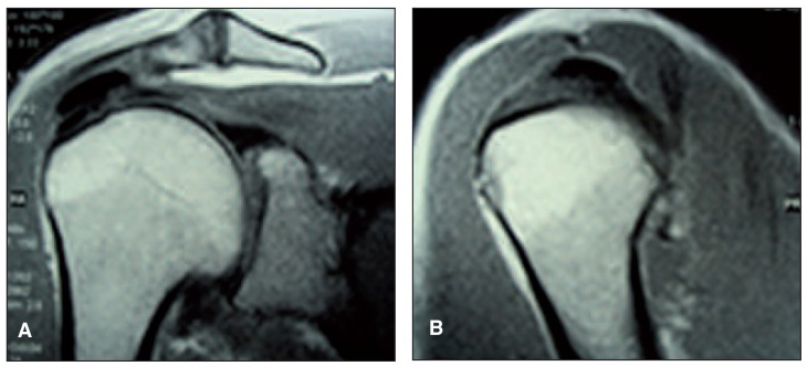 Calcified Lesions Can Predict Rotator Cuff Tears
