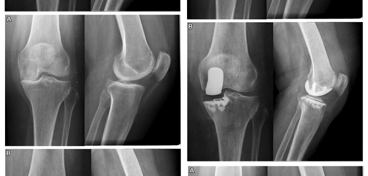 10-Year Follow-Up Data for All-Poly Uni Knees
