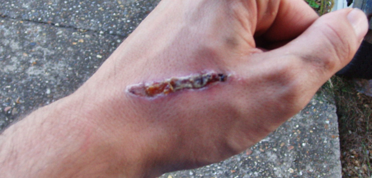 Myth Buster: Time to Hand Surgery Won’t Affect Infection Rate