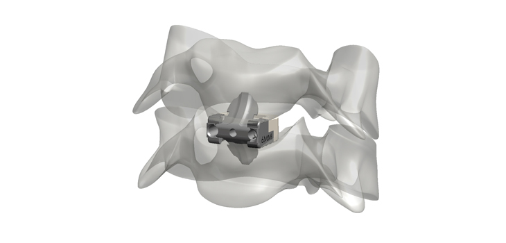 Pantheon Spinal Makes Another Acquisition With Incite Innovation
