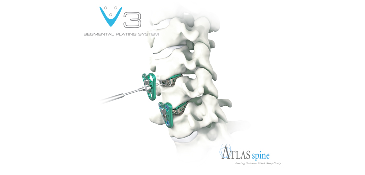 Atlas Spine Launches V3 Guided Segmental Cervical Plating System
