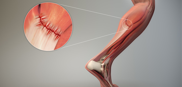 Risk for Recurrent Muscle Strain Can Last for 15 Weeks