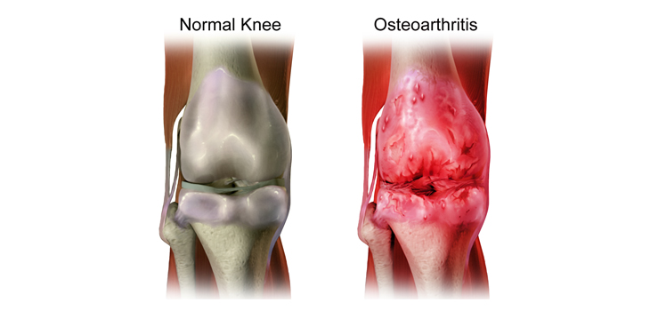 Extended Release Corticosteroid for Knee OA Pain