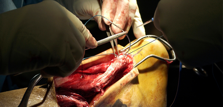 Delayed Achilles Rupture Repair Won’t Affect Outcomes