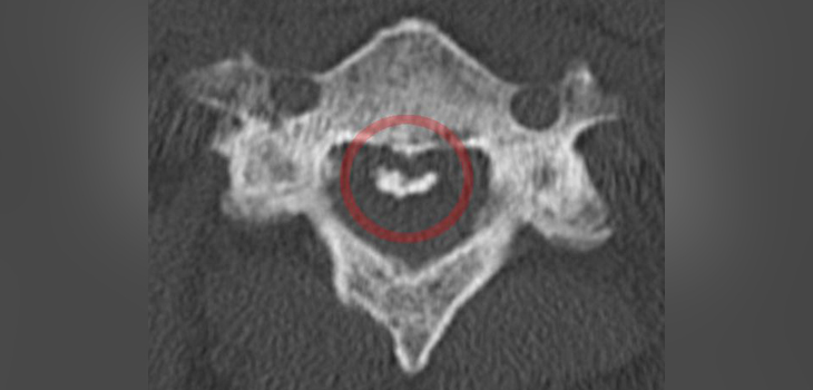 Link Between Motion and Ossification not so Strong After All