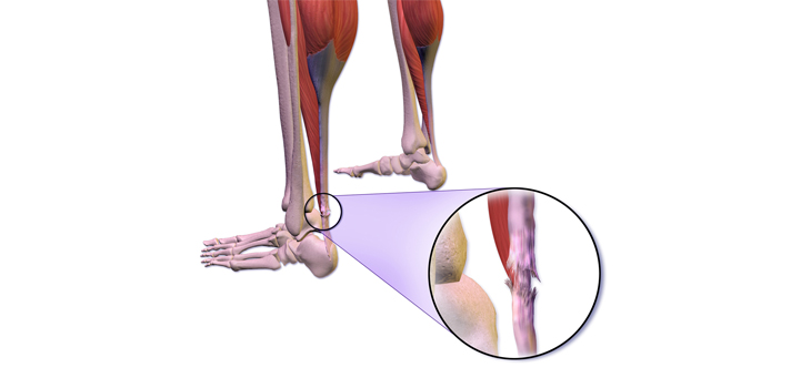 Early Walking in Brace Better for Achilles Tendon Rupture