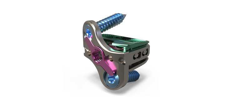 Atlas Spine Launches Stand-Alone Expandable Cervical Spacer