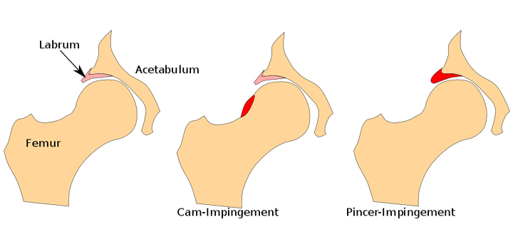 First Best Practices Guide for Femoroacetabular Impingement