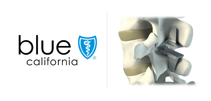 Blue Shield of California Sued Over coflex Denial