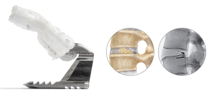 Evidence Builds for Annular Closure Device, Barricaid