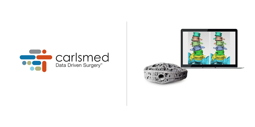 Carlsmed Raises $2.5M to Accelerate Launch of Custom Spine Implant