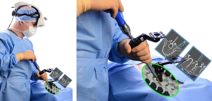 Augmented Reality Enters the Operating Room in First Spine Surgery