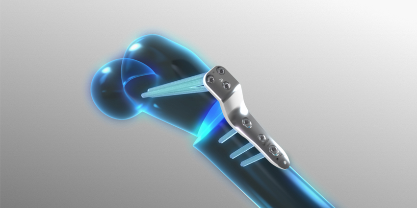 FDA and EU Regulators Clear New Pediatric Plating System