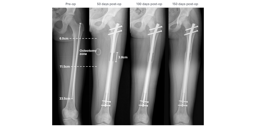 Magnetic Rod Technology Returns to Extremities