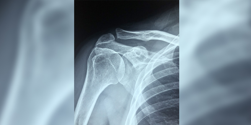 Capsular Reconstruction Outcome Data From HSS
