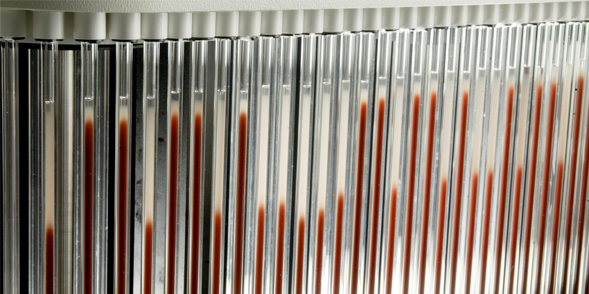 New Marker Tags Risk of Reinfection Post Treatment
