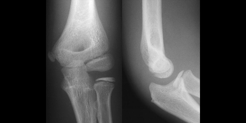 Either Docking or Modified Jobe Good for Elbow UCLR