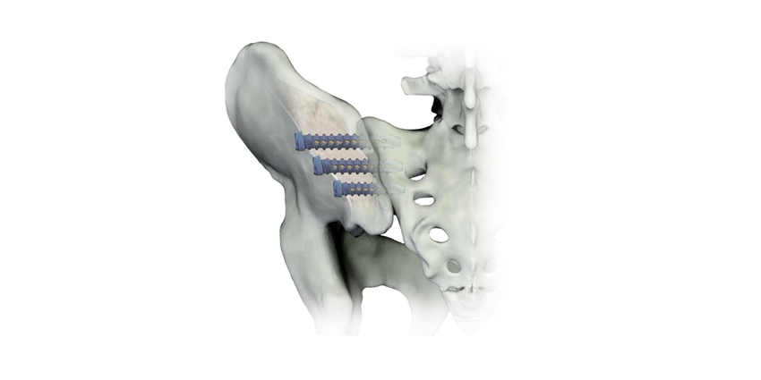Pantheon Acquires Sacroiliac Fusion Device From Osseus