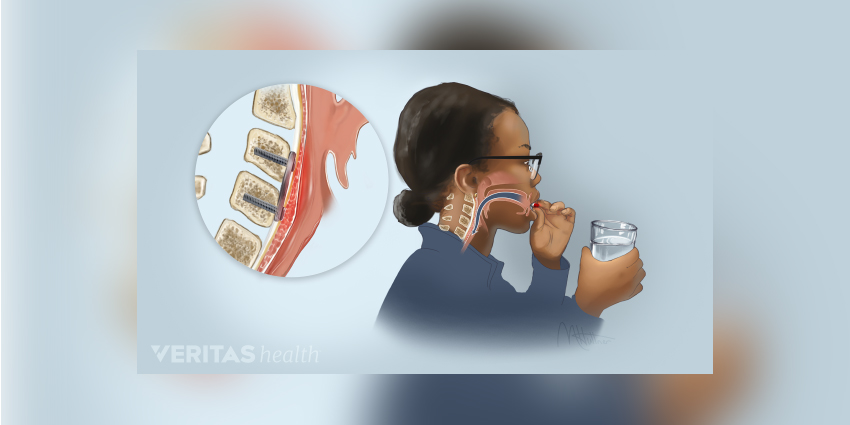 Topical Steroids Help Reduce Dysphagia After ACDF