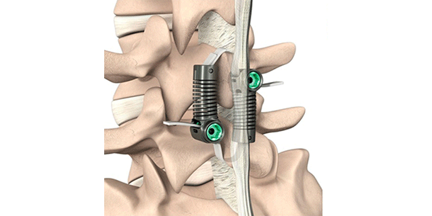 IDE Study Results Presented at IMAST for LimiFlex™