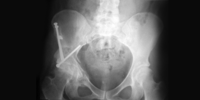 How Does Osteotomy Affect Acetabular Dysplasia?