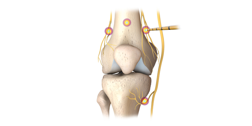 Study: New Data re: Cooled Radiofrequency Ablation for OA