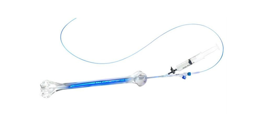 Fibula Treatment Added to Previously Cleared IlluminOss System