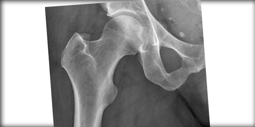 Standing and Supine Radiographs Accurate for Hip Joint Width