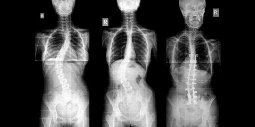 Asymmetrical PSO Effective for Multiplanar Correction in ASD