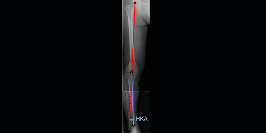 What Causes Mis-Aligned Knee Joints After Tibial Osteotomy?