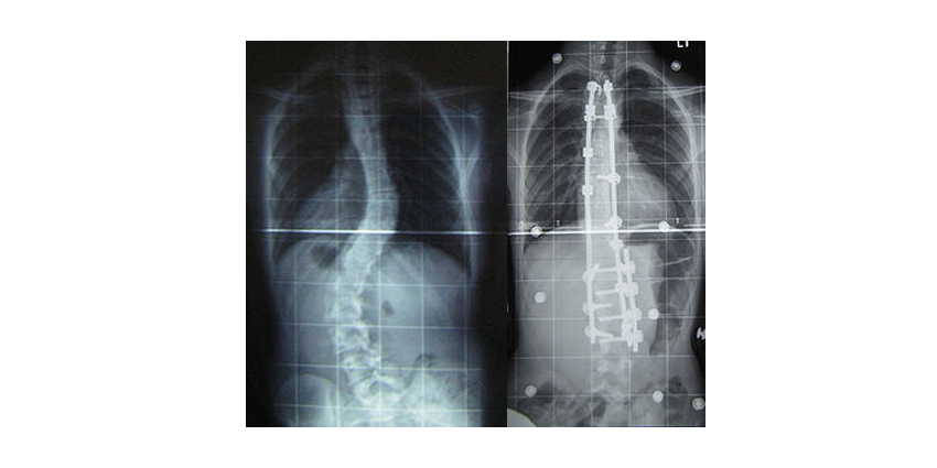 Studies on Selecting the Lowest Instrumented Vertebra for AIS