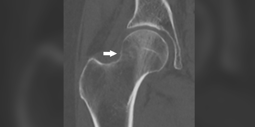 Nanoscale Bone Inflexibility Hip Fracture Risk Factor