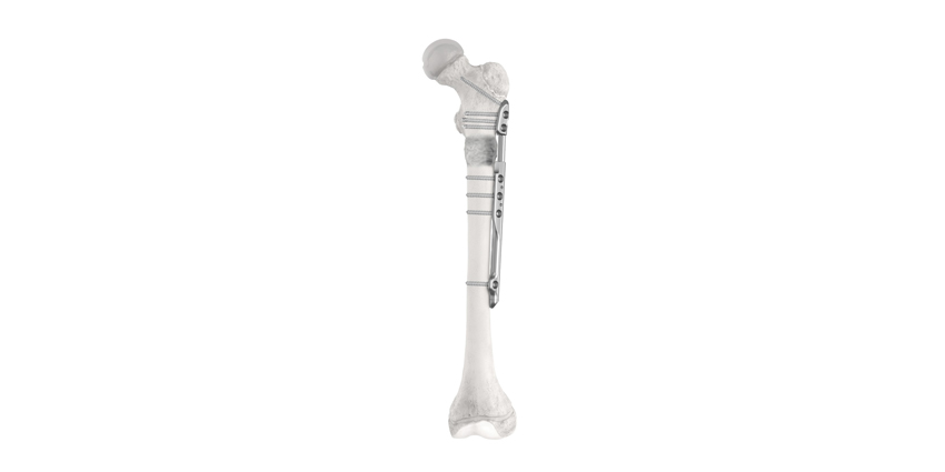 NuVasive Launches Limb Lengthening Plate as Alternative to Nail