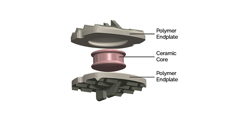 Rare FDA Approval for Simplify Cervical Disc