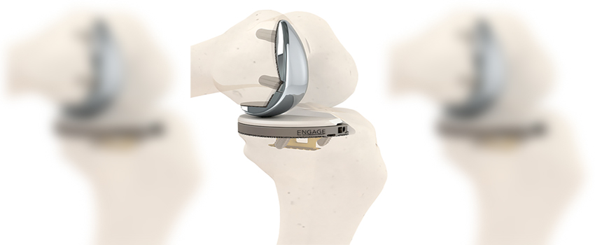 510(k) Clearance for 1st Cementless Partial Knee System in U.S.