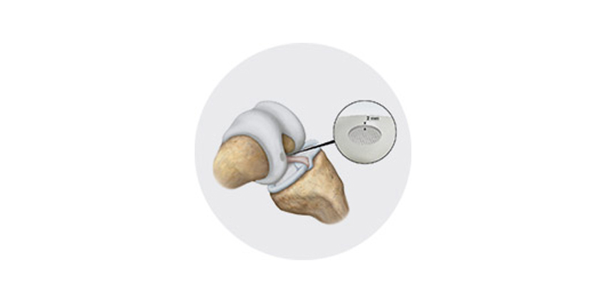 FDA Grants Breakthrough Designation for Agili-C