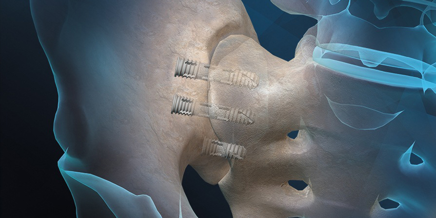 FDA Clears “Nano” Upgrade for SI Fusion System