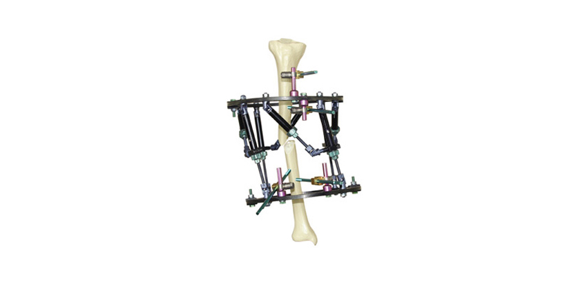 IMED Surgical Files Federal Lawsuit Over External Fixation System