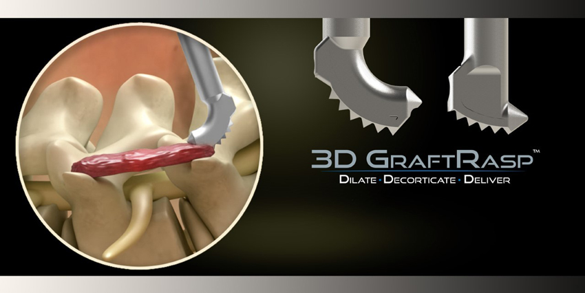 Novel 3D GraftRasp System Cleared by FDA