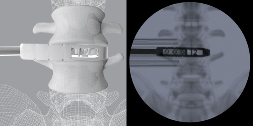 CoreLink Launches 3D Printed Instrument Set for OLIF System