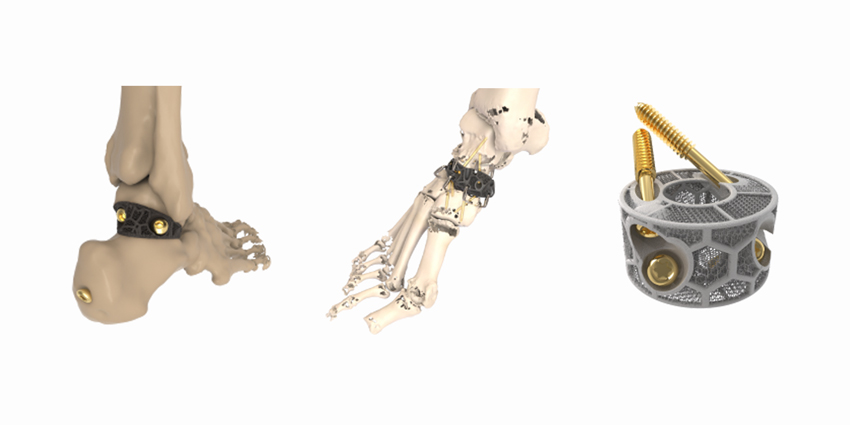 Additive Introduces Patient Specific Implant Locking Technology
